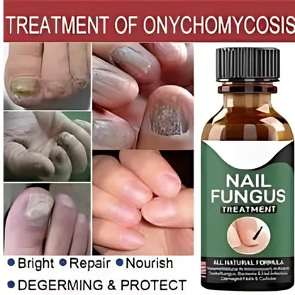 Nail Fungus Treatment Serum (10ml) | Get Healthy & Shiny Nails